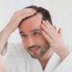 mens hair loss royal-oak mi